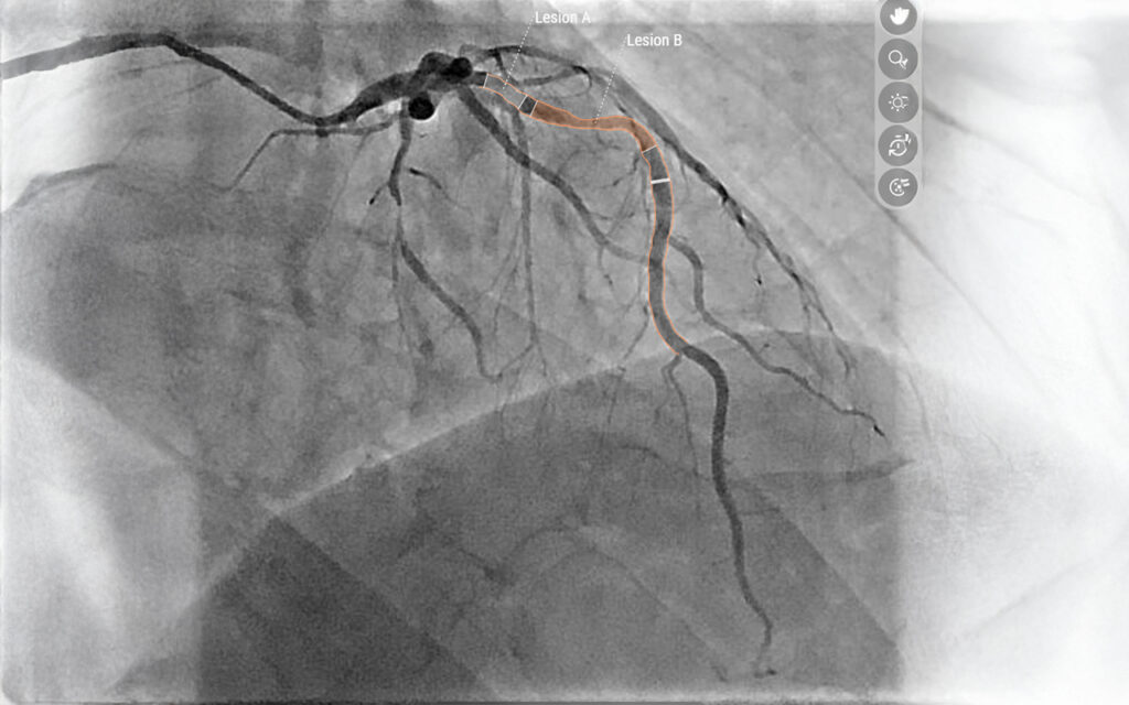 Künstliche Intelligenz (KI) revolutioniert Diagnostik koronarer Herzerkrankungen